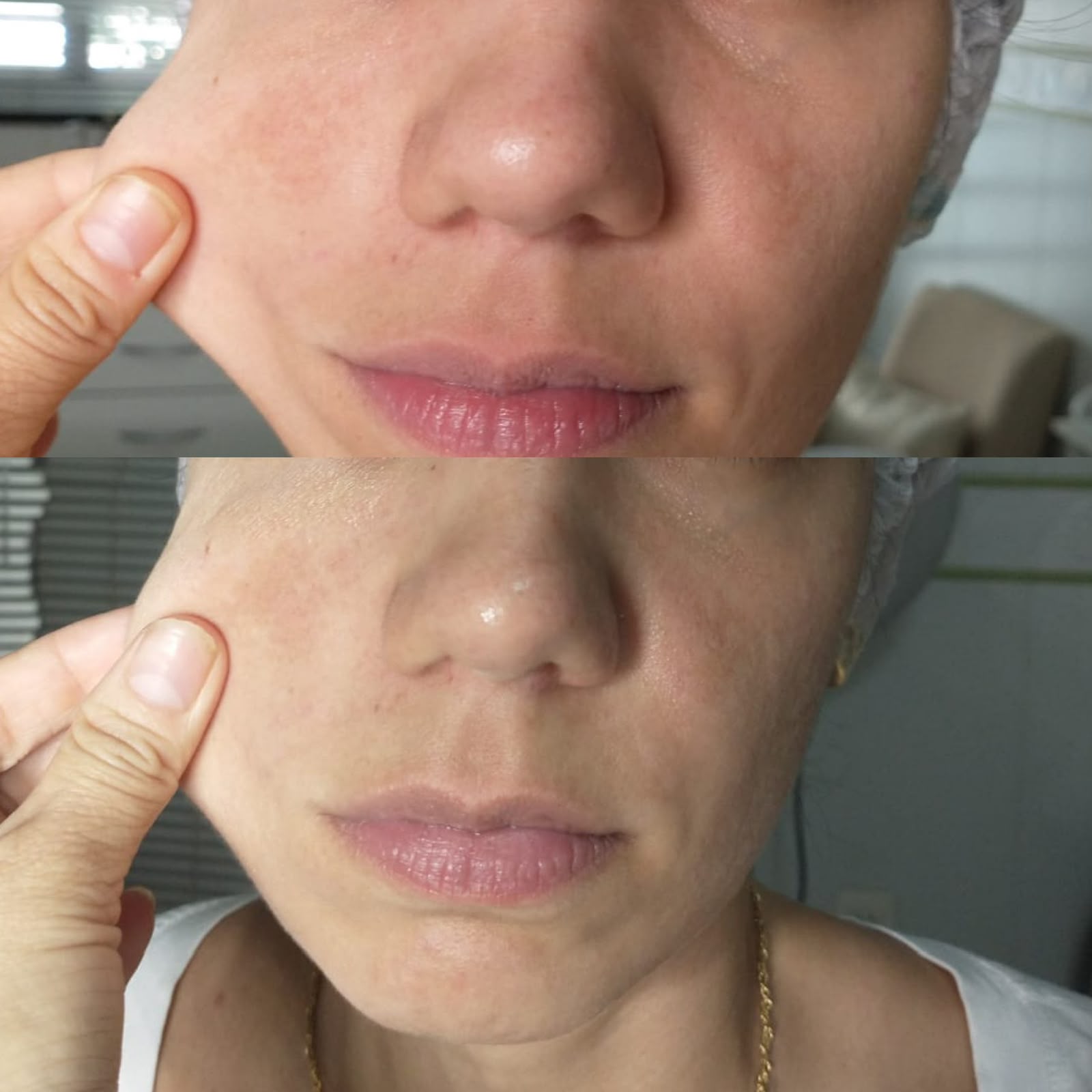 Bioestimuladores de Colágeno em Cacoal e Porto Velho - RO — Fabiana Rocha Centro de Estética