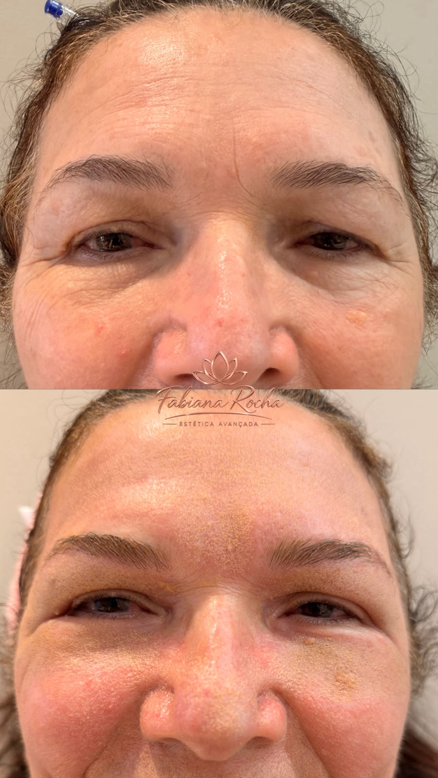 Laser CO₂ Fracionado em Cacoal e Porto Velho - RO — Fabiana Rocha Centro de Estética