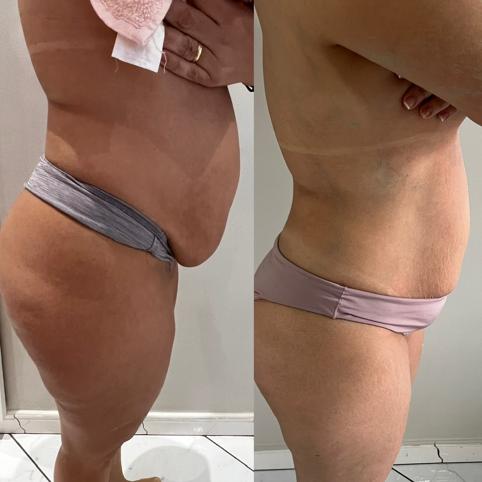Remodelação Corporal