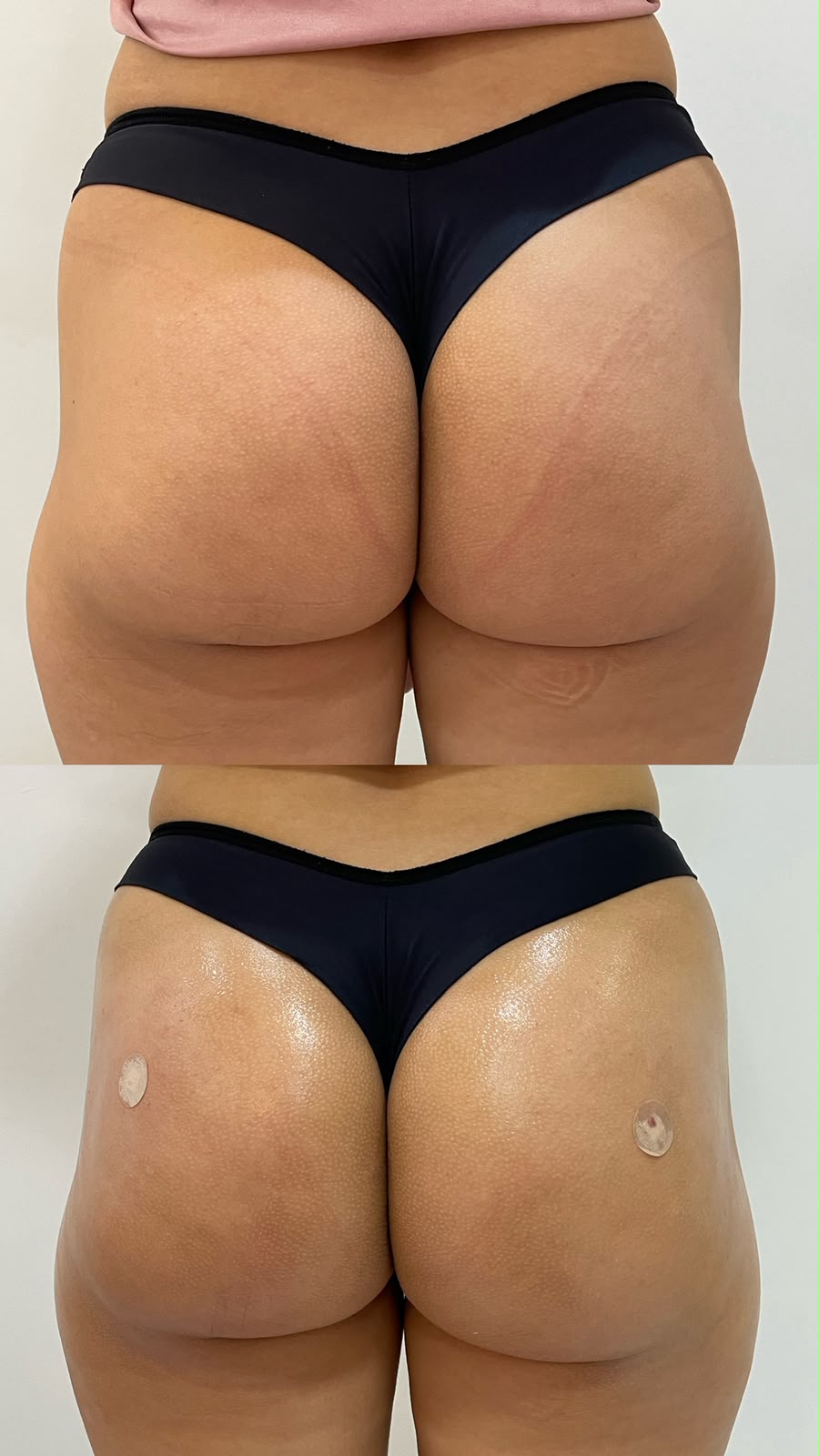 Harmonização de Glúteo em Cacoal e Porto Velho - RO — Fabiana Rocha Centro de Estética