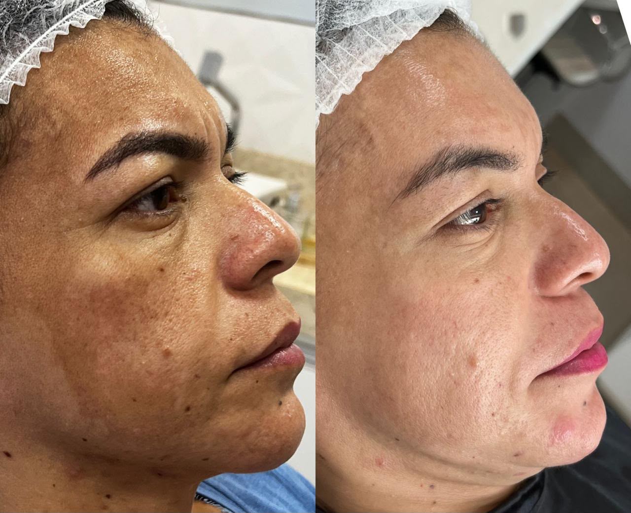 Peelings Químicos em Cacoal e Porto Velho - RO