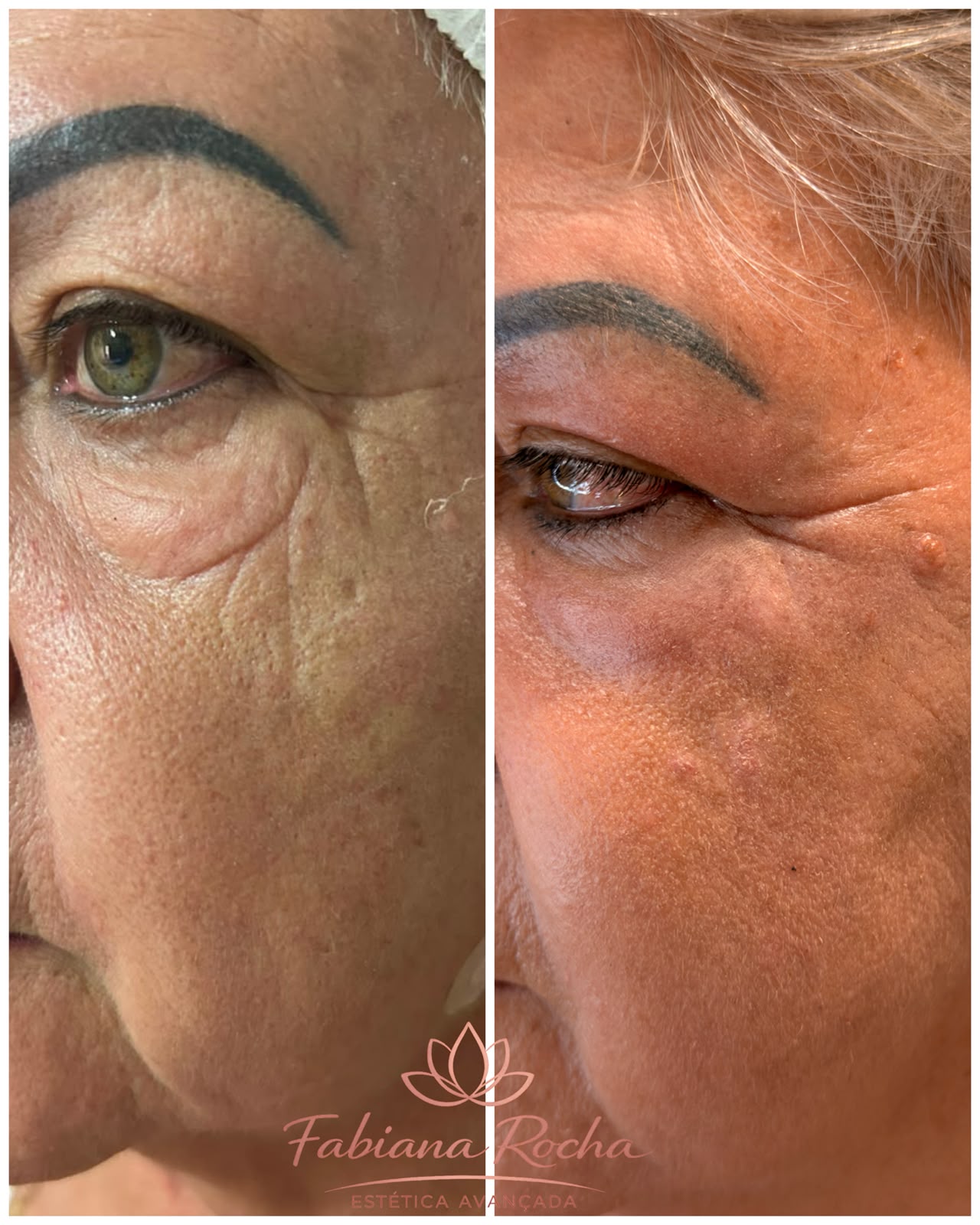 Botox Full Face em Cacoal e Porto Velho - RO — Fabiana Rocha Centro de Estética