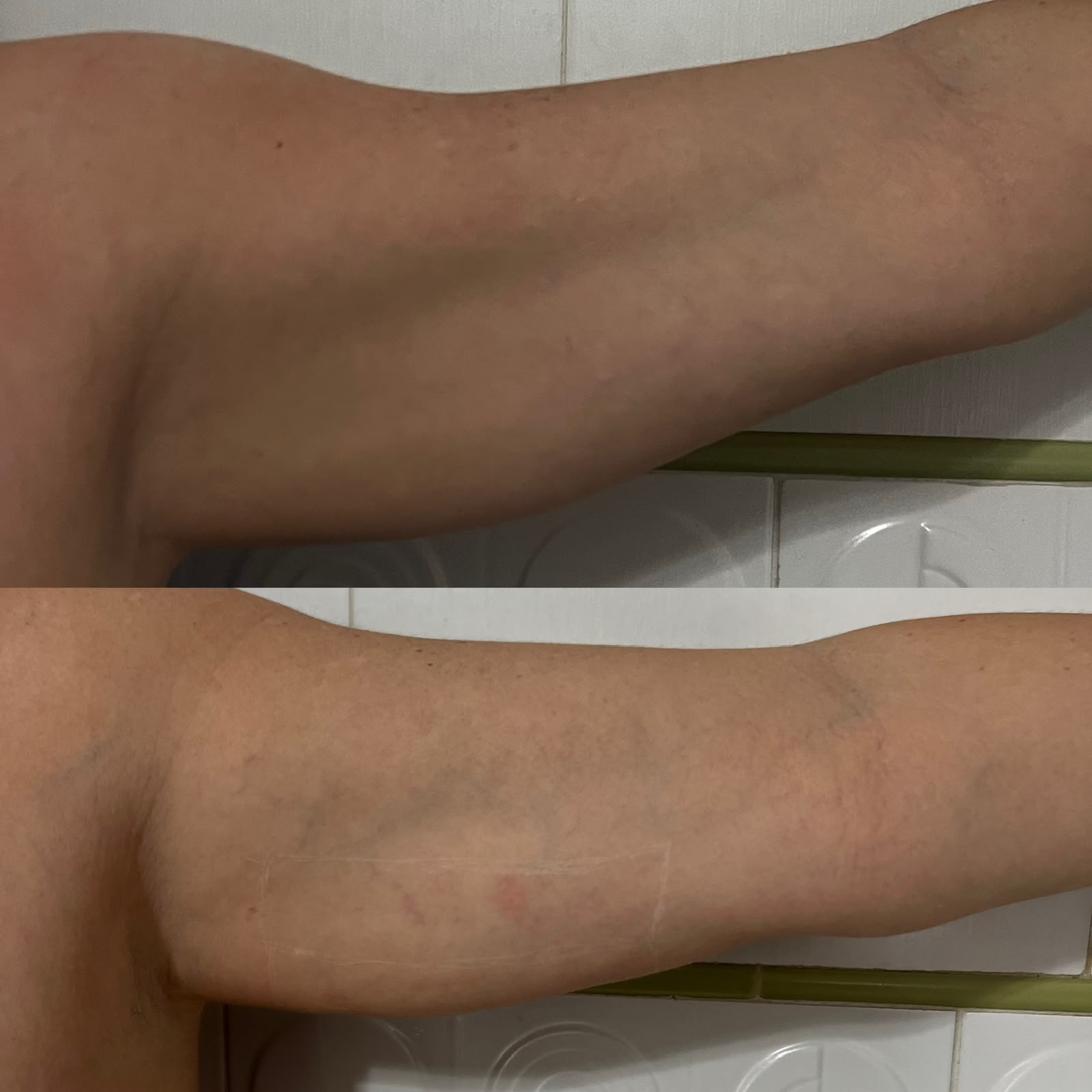Radiofrequência Corporal em Cacoal e Porto Velho - RO — Fabiana Rocha Centro de Estética